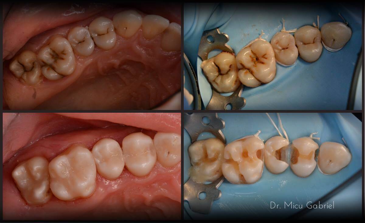 Read more about the article Tratamentul SingleVisit, solutia perfecta pentru pacientii fara timp!