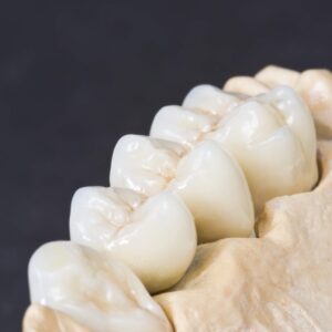 8 motive pentru a alege zirconiu la realizarea unei lucrari dentare!