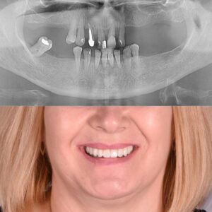 Before and after reabilitare orală completă la clinica SmileART Moinești