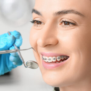 Tipuri de aparat dentar – avantaje, dezavantaje și prețuri
