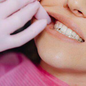 Sângerarea gingivală: cauze, factori de risc, tratament