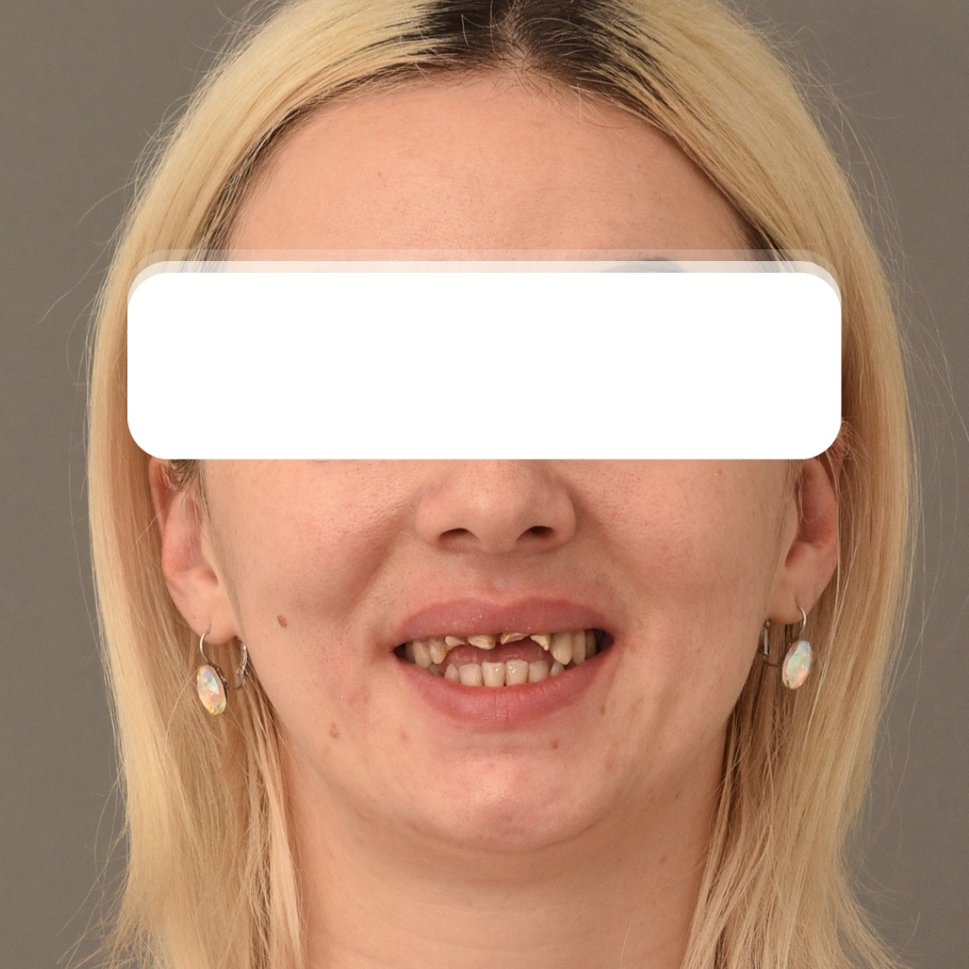 Înainte tratament