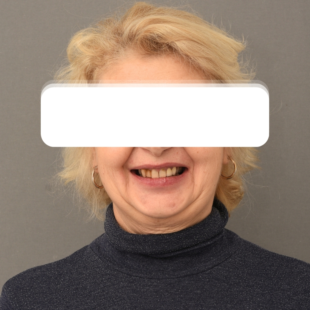Înainte tratament
