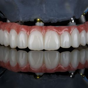implant-dentar