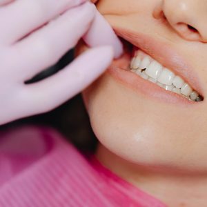 Consult parodontal sângerare gingivală